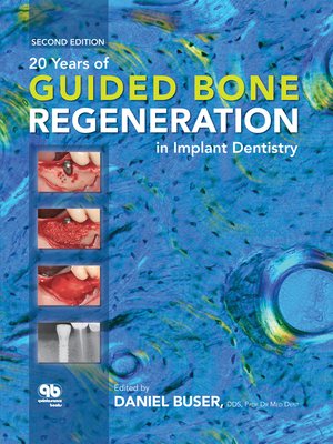 cover image of 20 Years of Guided Bone Regeneration in Implant Dentistry